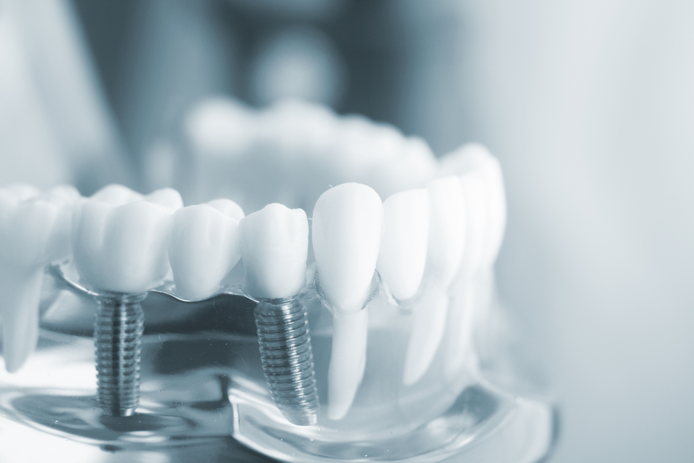 Dental Implants Information To Help You Decide