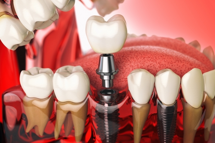 How Dental Implants Can Change the Life of a Person