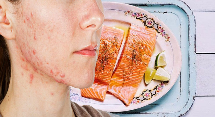 6 Healthy Guidelines to Reduce Acne